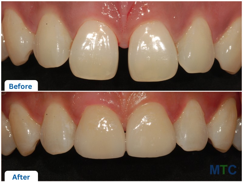 Dental laminates before and after