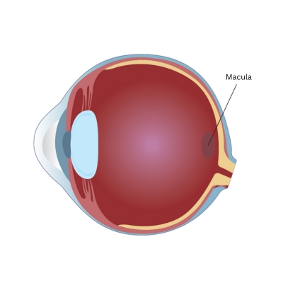 Macular edema