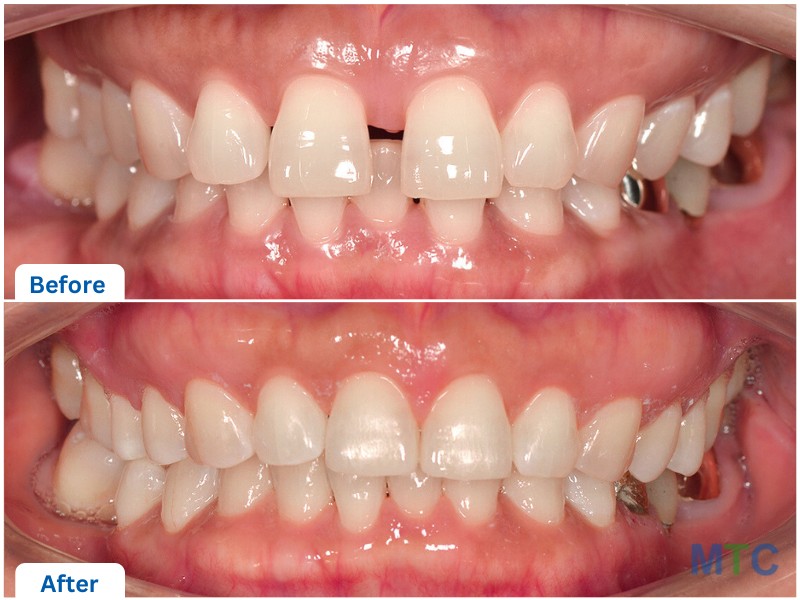 Orthodontic teeth correction before and after images