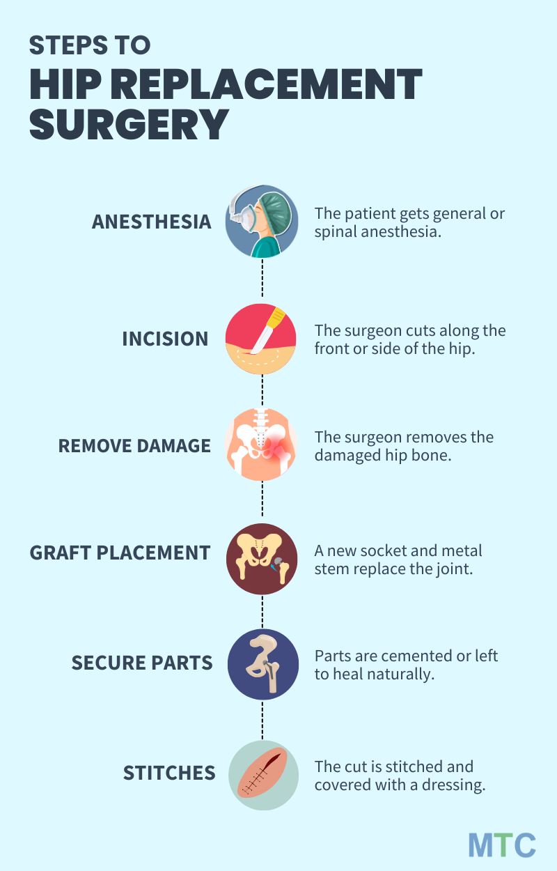 Steps to Hip Replacement Surgery