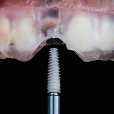 Computer generated Surgical Template through which the dental implants are inserted