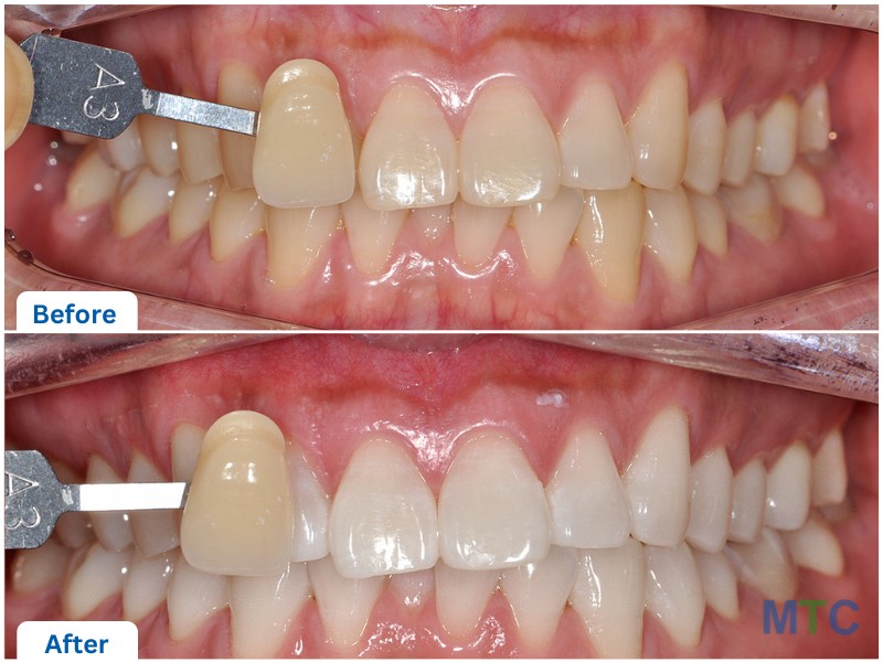 Teeth Whitening before and after images