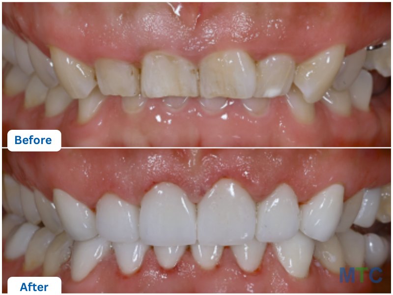 Dental Veneers before and after images