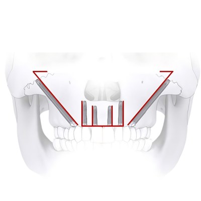 Zygomatic implants