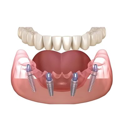 All-on-4 implants showing four implants supporting a full arch of teeth