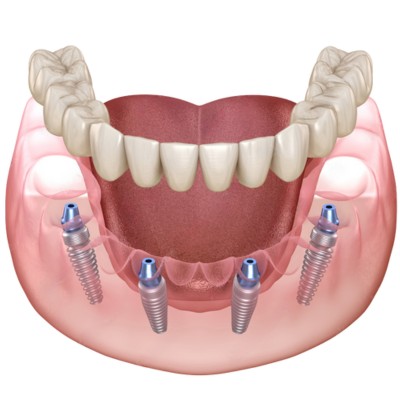 all on 4 dental implant