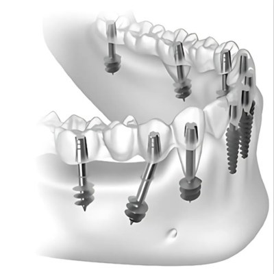 Basal Implants