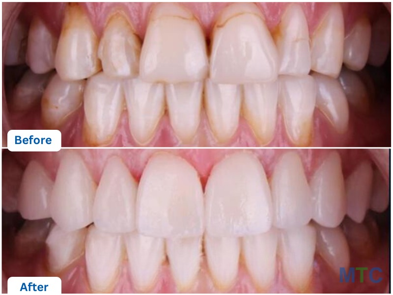 porcelain veneers