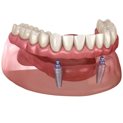 implant supported overdenture