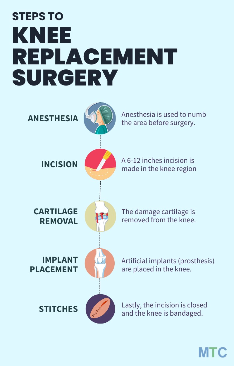 Procedure of Knee replacement surgery surgery