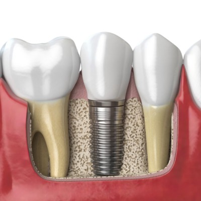 Dental implant