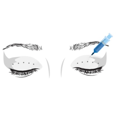 Non-surgical Blepharoplasty(Botox)