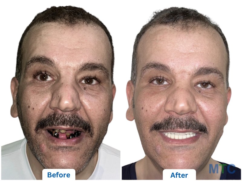 before after image of dental veneers in bangalore