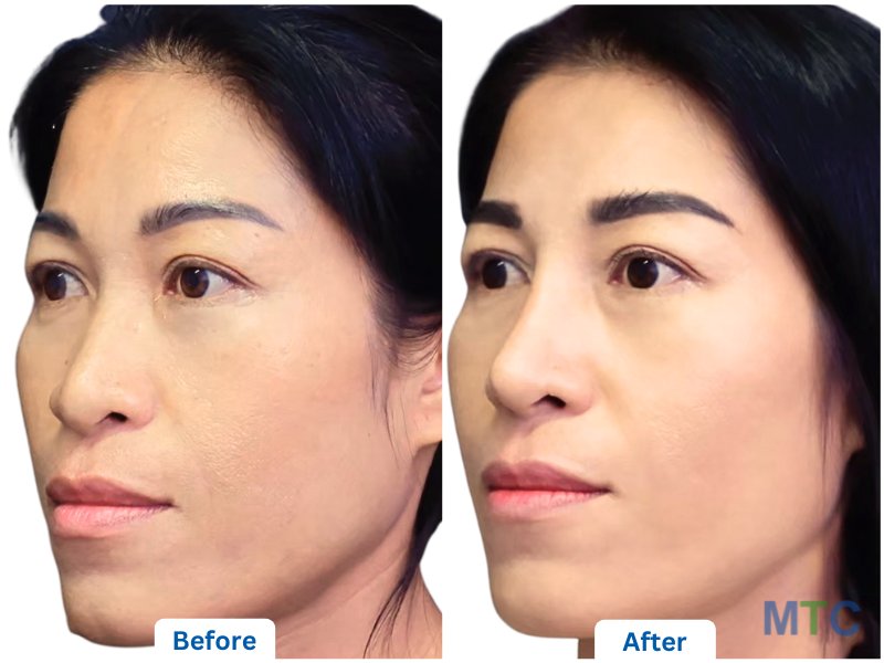 Rhinoplasty: Before and After