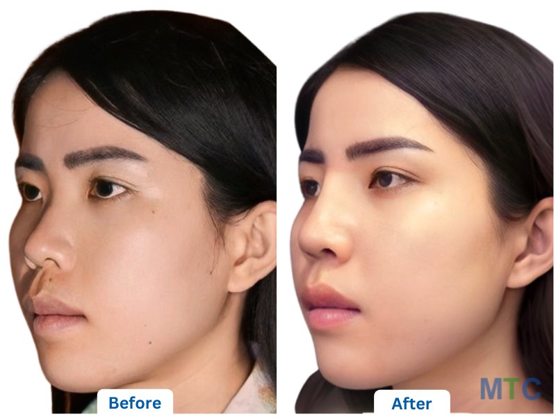 Rhinoplasty: Before and After