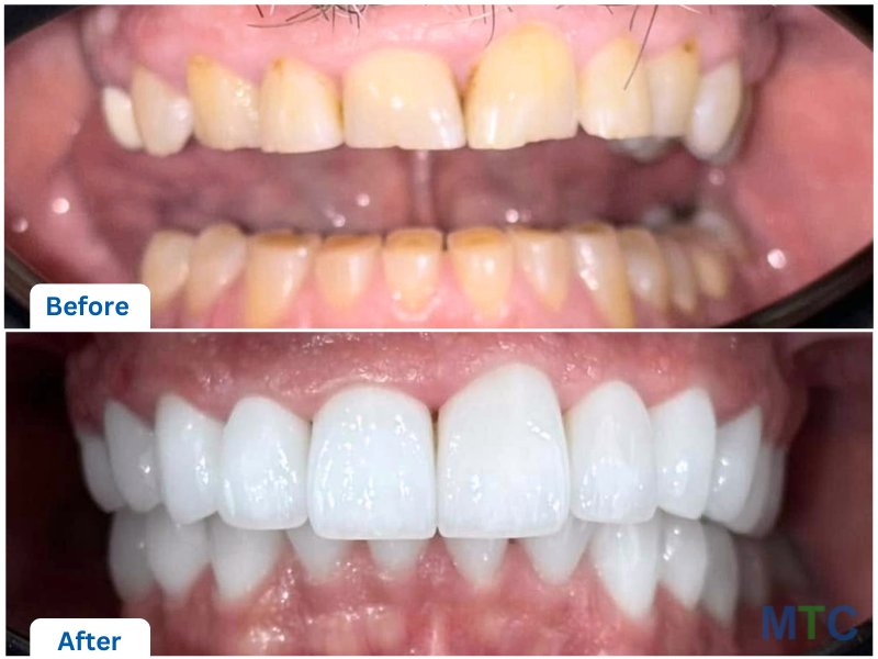 Before & After_Dental veneers