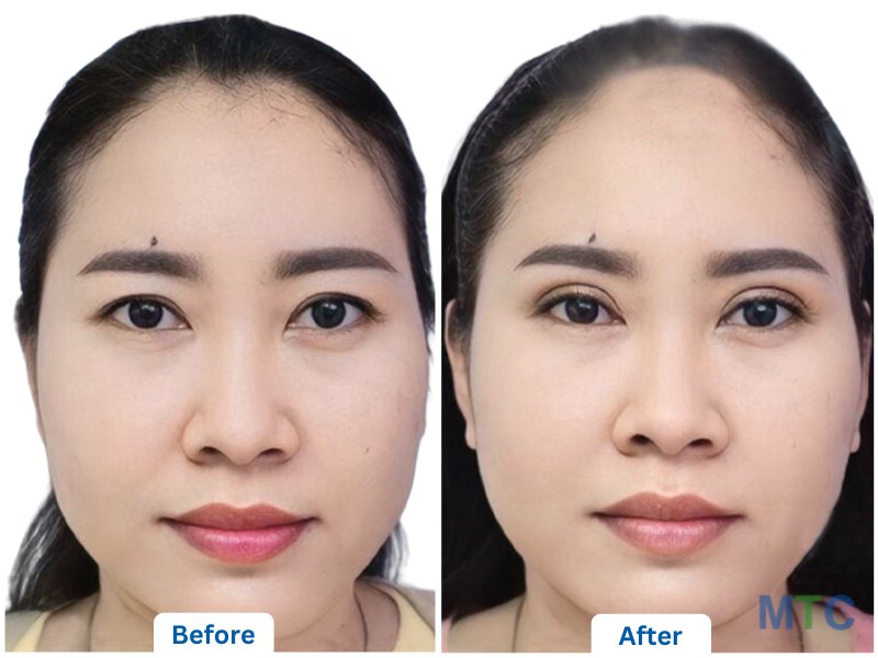 Double Eyelid Surgery