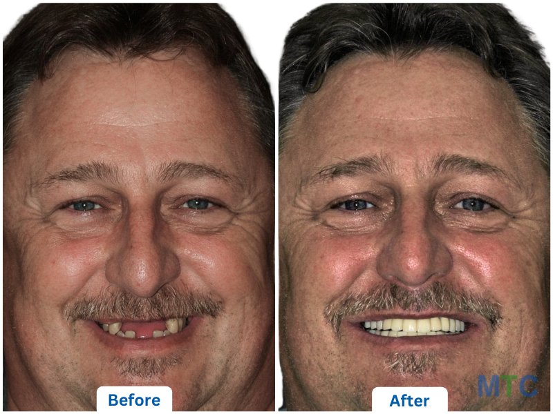 Results of Patients Who Underwent Dental Implants in Mumbai