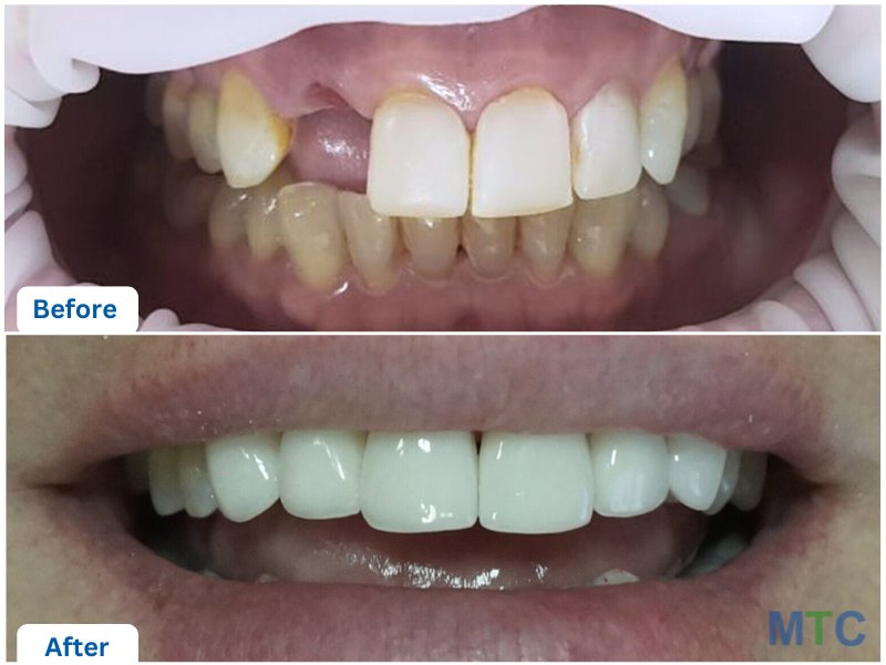 Before and After Dental Crowns and Bridge in Bali