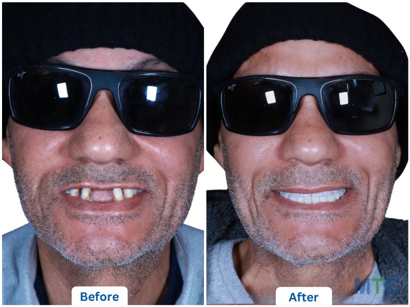 before after image of dental veneers in bangalore