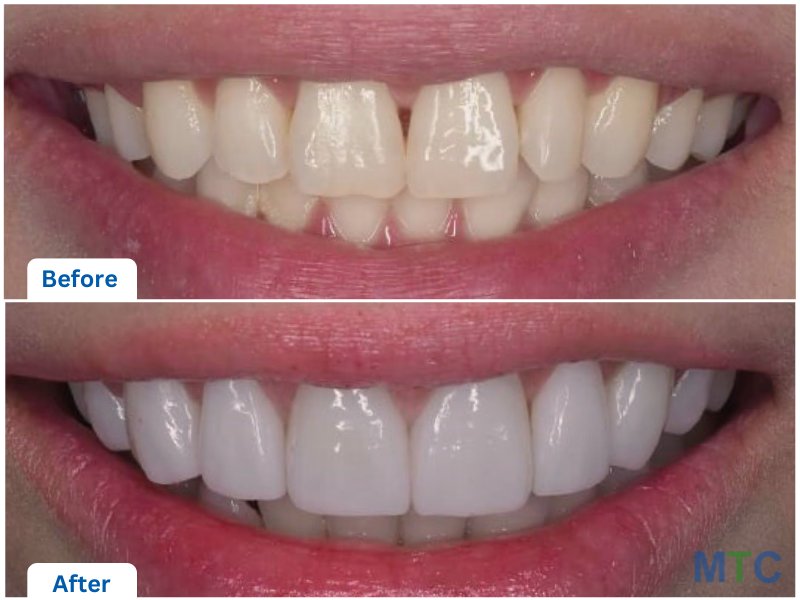 E-max Veneers