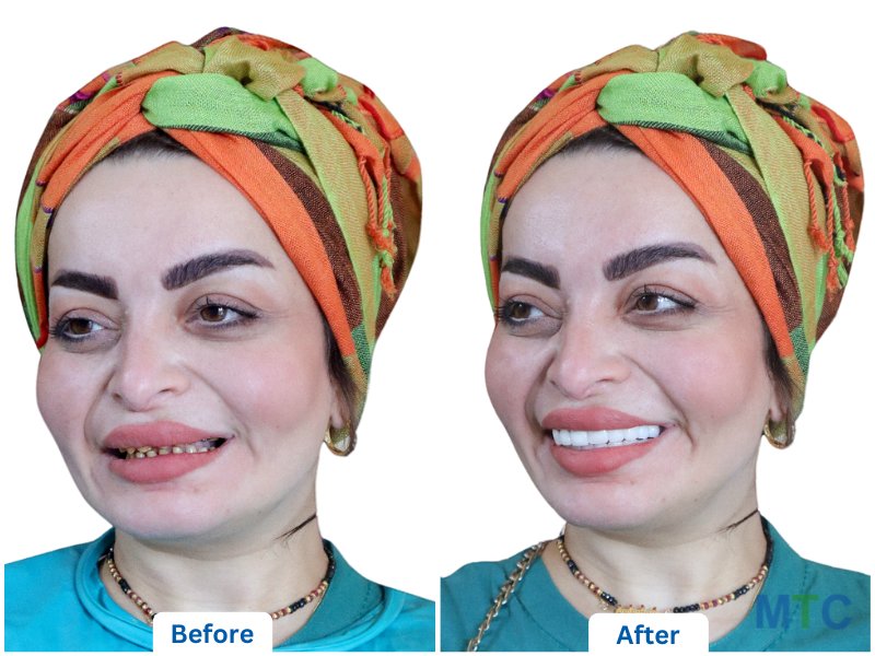 before after image of dental veneers in bangalore