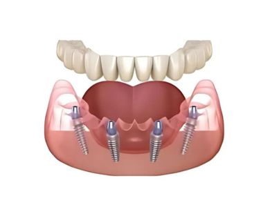 all on 4 dental implants