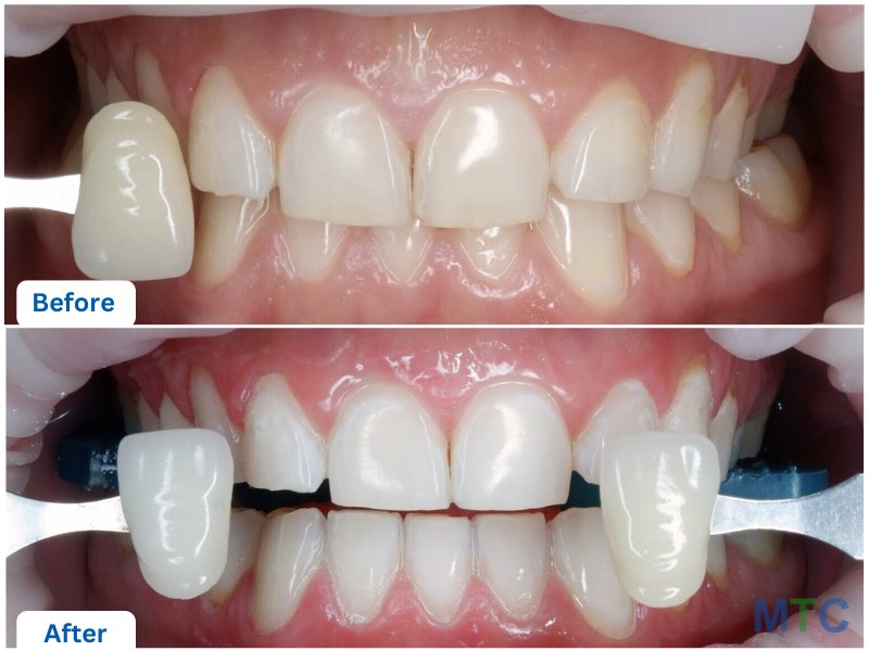 Before & After Teeth Whitening