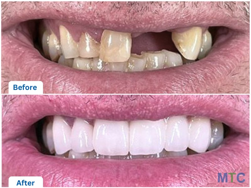 Dental Crowns & bridge