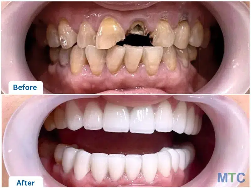 Before & After_Porcelain Crowns