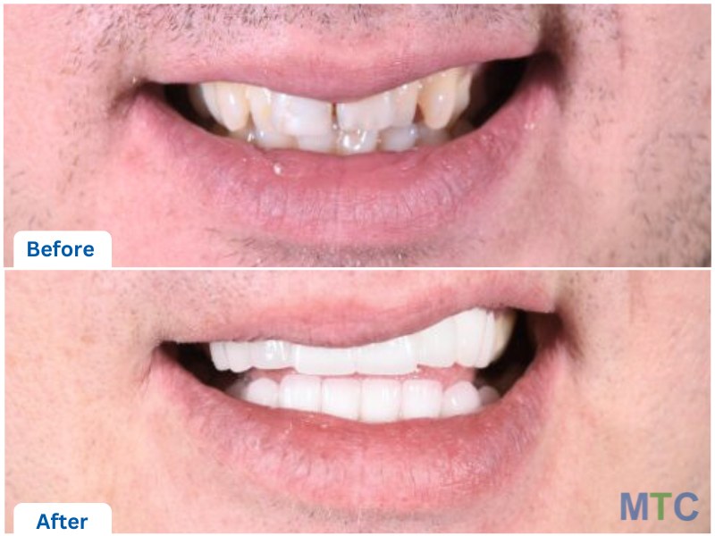 Before and after dental crowns