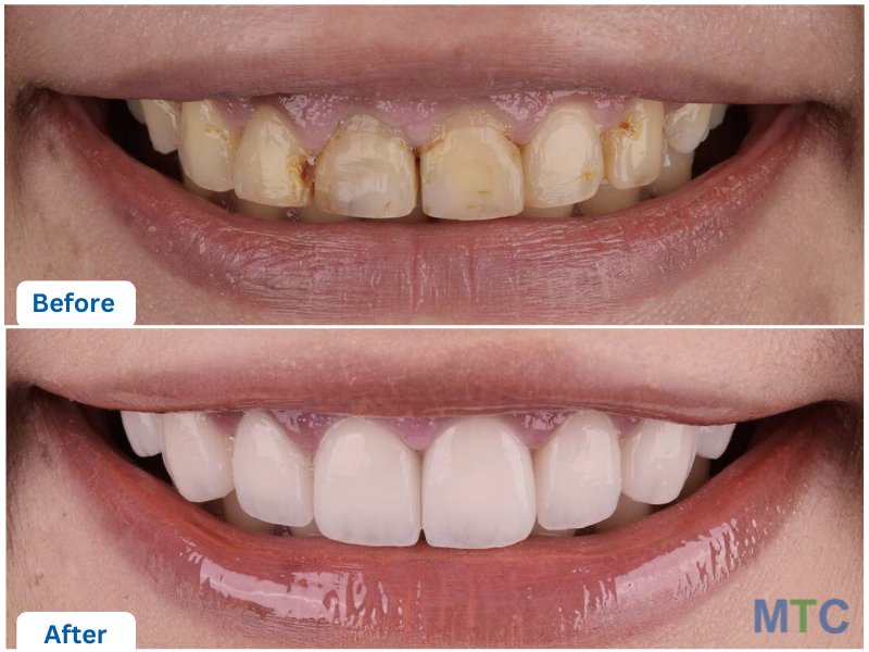 Dental Crowns in Phuket