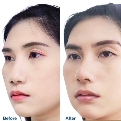 Closed Rhinoplasty Before and After