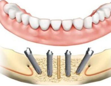 All on 4 dental implants