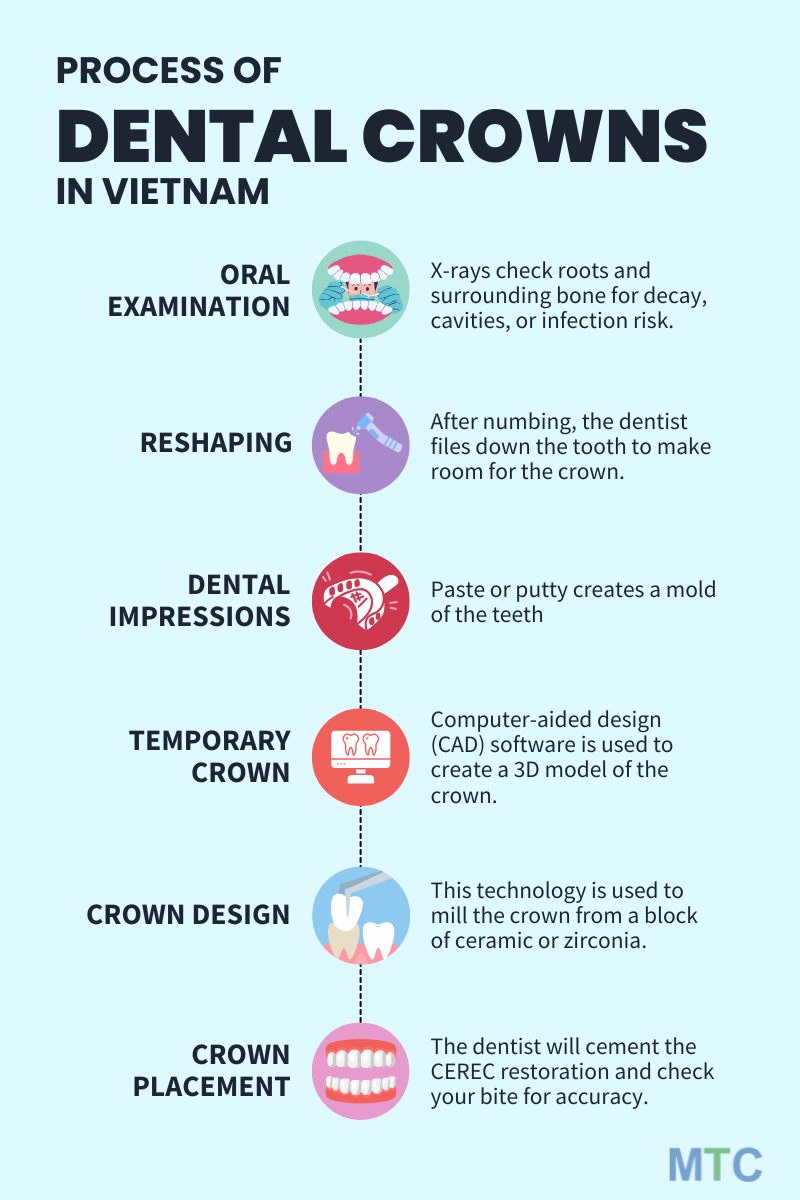 Process of dental crown placement in Vietnam