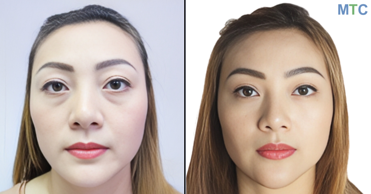 Lower Blepharoplasty in Thailand