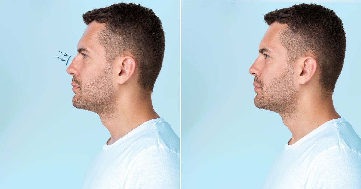 Male Rhinoplasty in Seoul, Korea