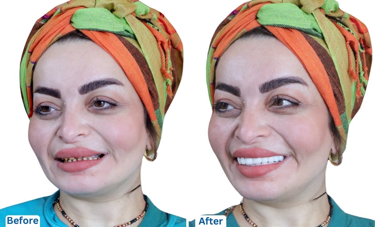 Dental Veneers in Bangalore: A Guide to Transforming Your Smile