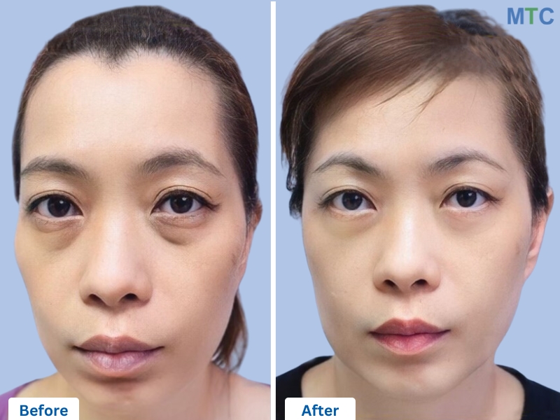 Lower Blepharoplasty