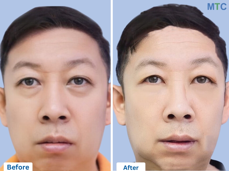 Lower Blepharoplasty