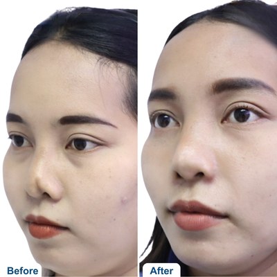 Open Rhinoplasty Before and After