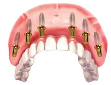 all on 6 dental implants