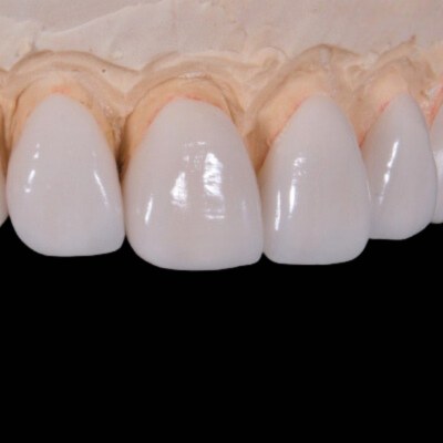 Porcelain Veneers on a black background