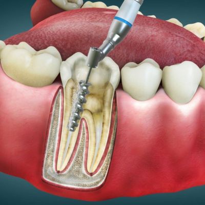 Procedure of root canal treatment