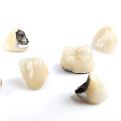 Porcelain-fused-to-Metal Crowns