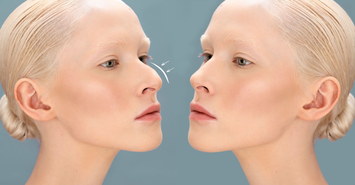 Caucasian Rhinoplasty in Seoul, Korea