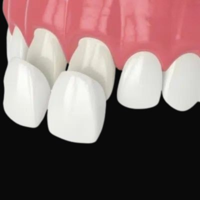 Composite veneers on a black background