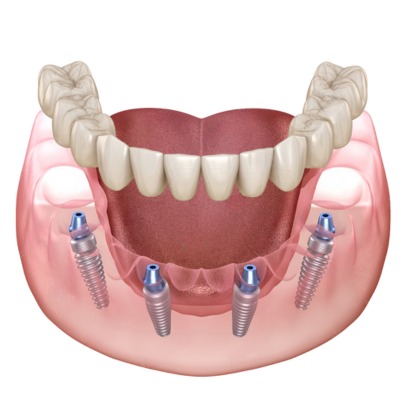 All on 4 Dental Implants