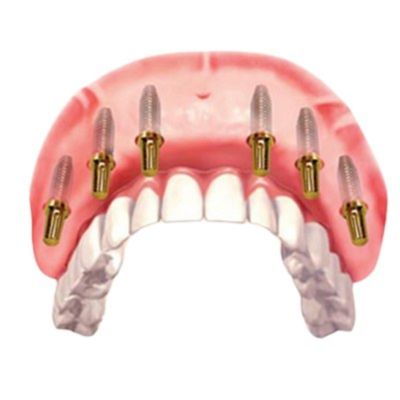 all on 6 dental implants