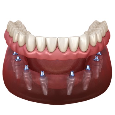 Diagrammatic representation of all on 8 dental implants in lower jaw